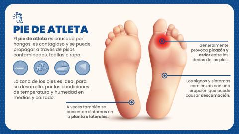 infografía pie de atleta